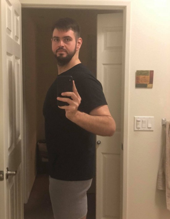 美小伙为爱减重270斤做手术去除多余松弛皮肤